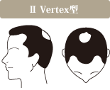 ⅡVertex型