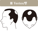 ⅢVertex型