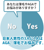 日本人男性の3人に1人はAGA、薄毛でお悩みです